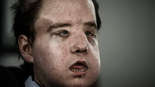 นายเจอโรม อามง วัย 43 ปี ได้รับใบหน้าของผู้บริจาควัย 22 ปี