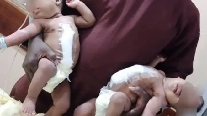 Kwara: Dókítà 66 ló síṣẹ́ abẹ fún àwọn ìbejì tó lẹ̀pọ̀ ní ilé ìwòdan fasiti Ilorin