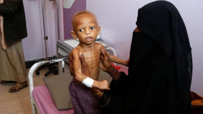 طفل يمني يعاني من سوء التغذية عمره سنتين، في قسم سوء التغذية بمستشفى السبعين، حيث يتلقى العلاج في 13 فبراير /شباط 2021 بصنعاء.