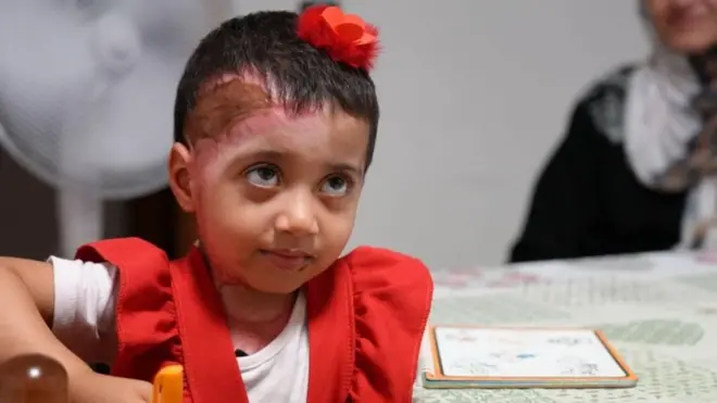 Zeina je jedna od nekoliko hiljada povređenih stanovnika Gaze koji su nedavno evakuisani radi lečenja u inostranstvu