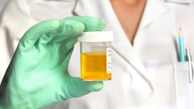 รูปตัวอย่างปัสสาวะ