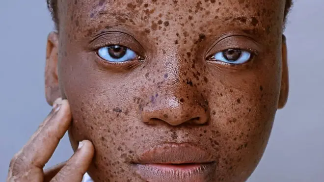 Nigerian Girl wit skin condition dem call vitiligo