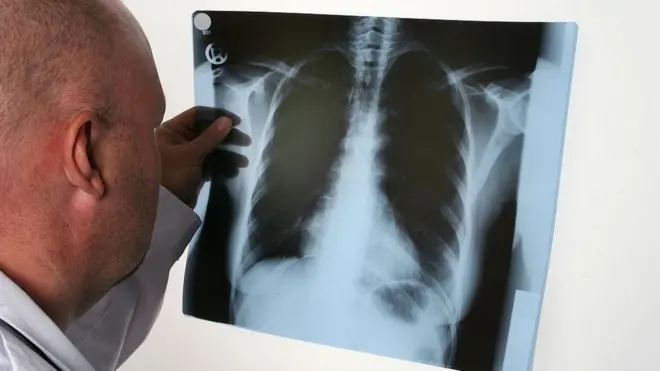 Vərəm xəstəsi, vərəm infeksiyası