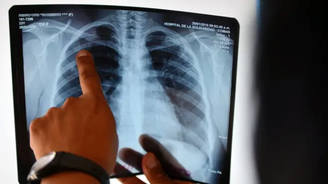 снимок легких