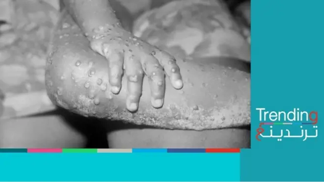 جدري القرود، فيروس نادر يثير القلق