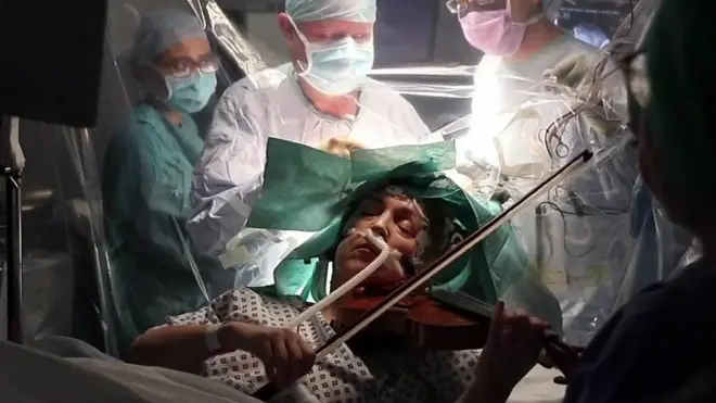 뇌수술 바이올린