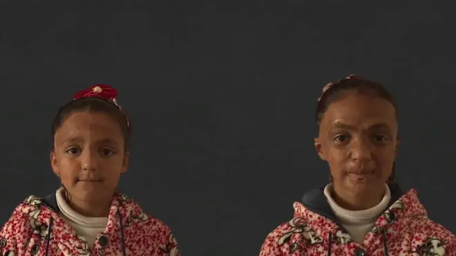 Рахаф і Камар отримали опіки через вибух снаряду