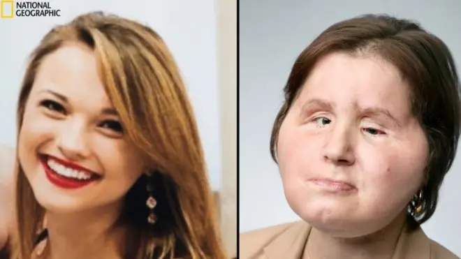 Katie Stubblefield ameliyat öncesi ve sonrası