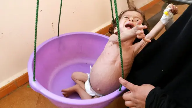 Malnourished Zakaria Yahya (21 months) is weighed in a hospital in the northwestern city of Saada, Yemen, November 21, 2018.