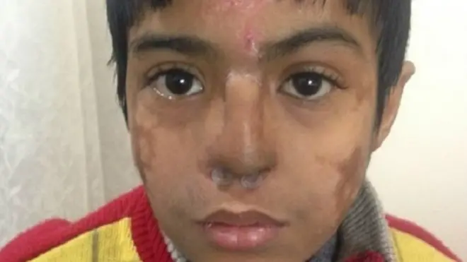 Arun Patel's nose was badly damaged and disfigured when he suffered from pneumonia as a baby