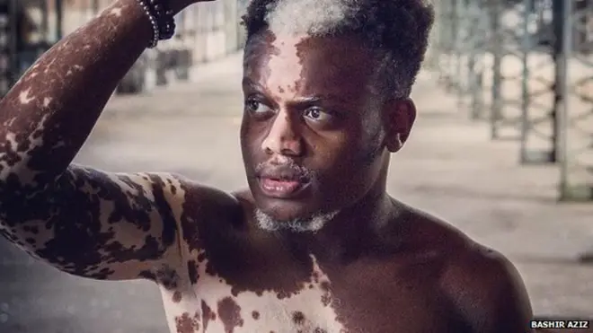 People dey talk say Bashir Aziz be like cow or zebra. Na piebaldism, wey be sister to Vitiligo, na im Aziz get.