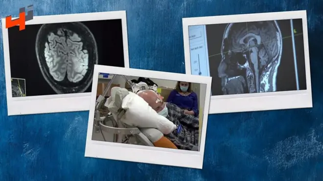 طريقة مبتكرة لمعالجة الصرع