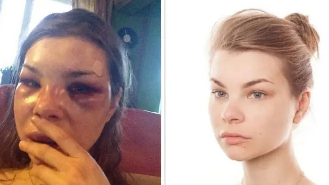 Фото Анны Жавнерович до и после побоев