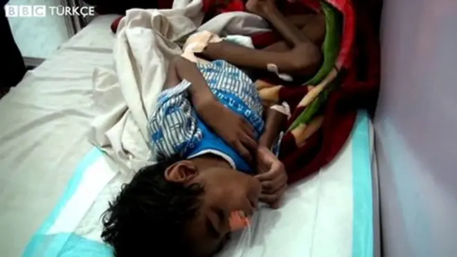 Yemen kolera salgını