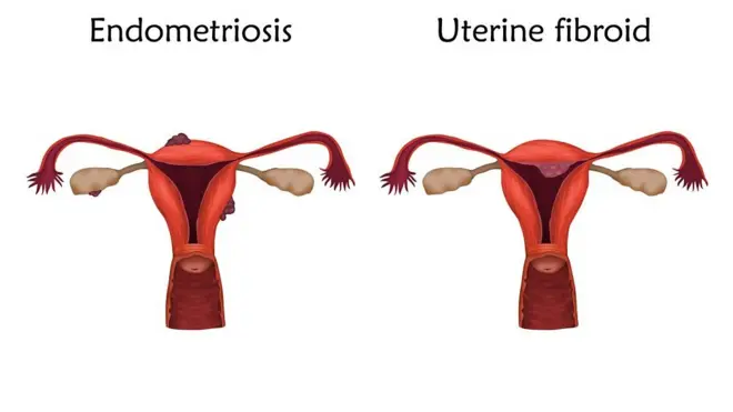 Fibromes Uterins
