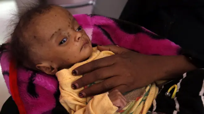 A Yemeni woman holds her malnourished child receiving treatment amid worsening malnutrition at a hospital in Sana"a, Yemen, 24 November 2017.