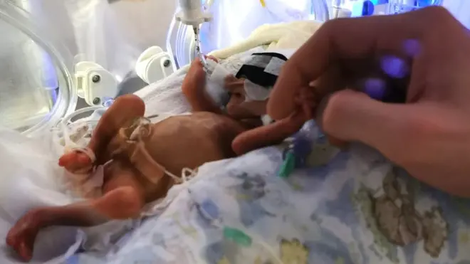 When Sofia was born she weighed just 500g (1.1lb) and could fit in her mother's hand