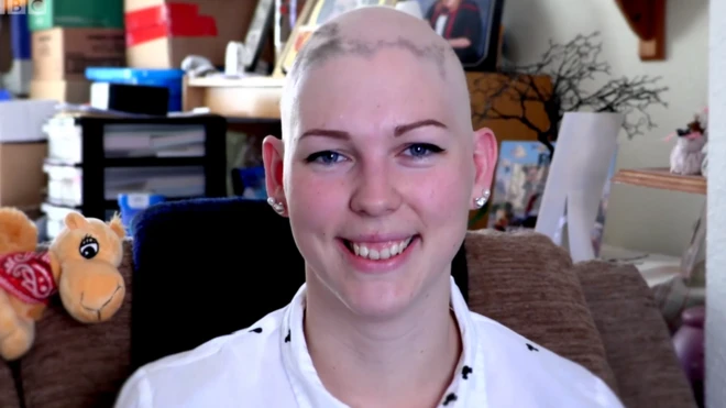 탈모는 두 여성의 삶을 어떻게 바꿨을까