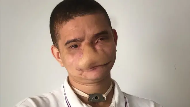 Samuel posa para foto e mostra os impactos do acidente com fogo em seu rosto
