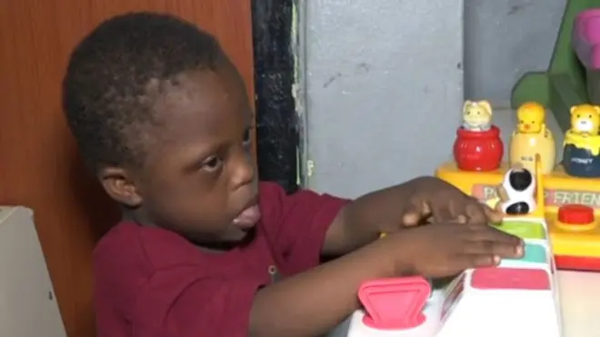 Nwata nwere Down's Syndrome