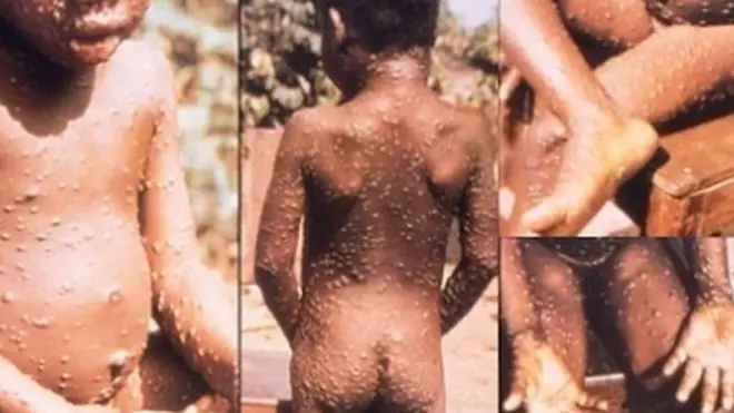 Monkeypox infection on top pickin dem