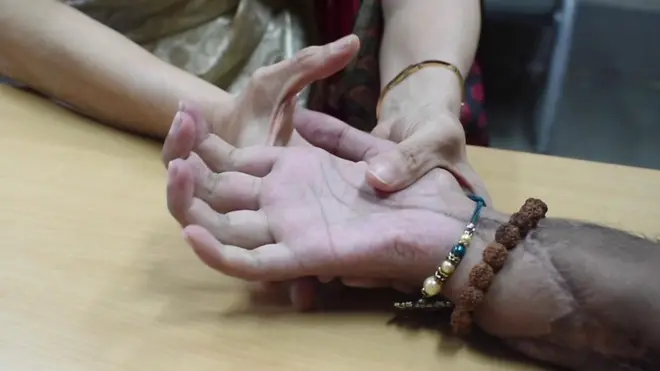 హ్యాండ్ ట్రాన్స్‌ప్లాంటేషన్‌