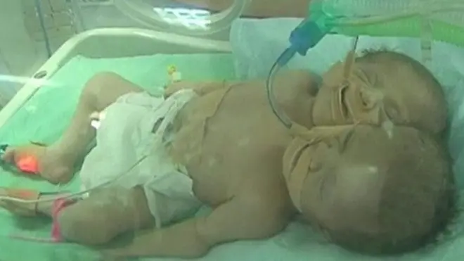 توأمتان في غزة