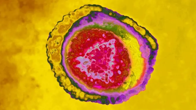 El virus del herpes humano tiene ocho cepas. La 1 causa herpes labial, pero también puede ser encontrada en los genitales; la 2 causa herpes genital, la 3, varicela y herpes zoster; la 4 (o EBV), mononucleosis infecciosa y linfoma de Burkitts; la 5 o citomegalovirus causa el síndrome de la mononucleosis; la 6 y la 7, roséola y la 8 causa sarcoma de Karposis y linfoma.