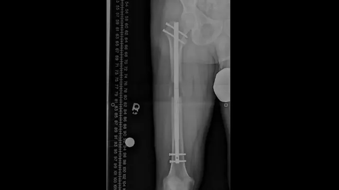 Placa de la cirugía