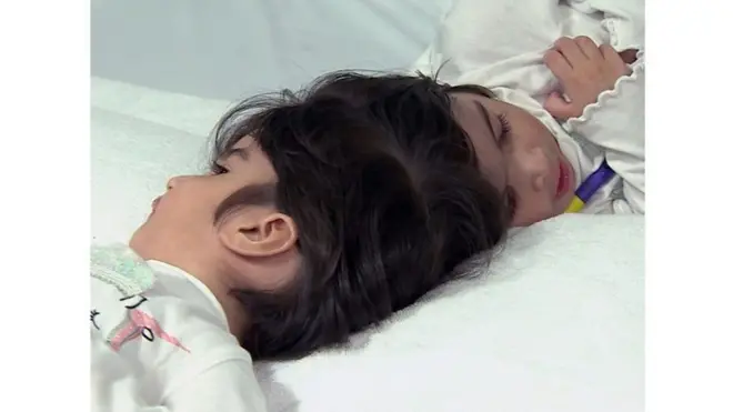 샴쌍둥이 사파와 마르와