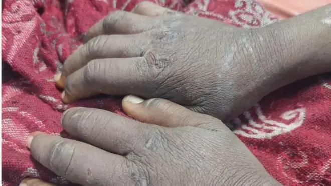 పనిమనిషిని కొట్టి, వాతలు పెట్టి తీవ్రంగా హింసించారు.