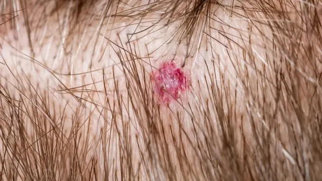 Manchas e pintas que aparecem no couro cabeludo podem ser um indicativoroleta europeia onlinemelanoma