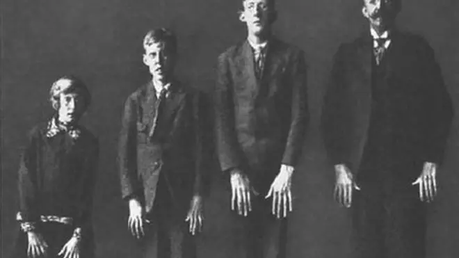 Familia con Síndrome de Marfan