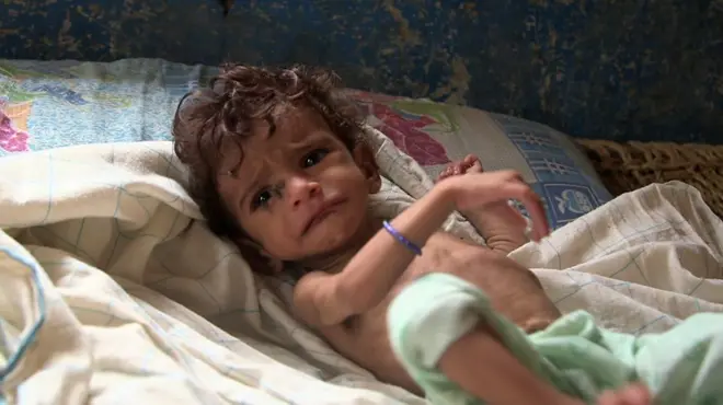 أطفال اليمن يعانون من سوء التغذية والمجاعة تهدد أغلب السكان