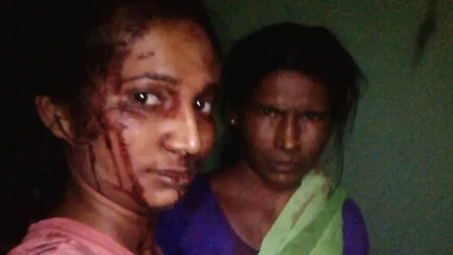 పులితో పోరాడిన తర్వాత రూపాలి తన తల్లితో కలిసి సెల్ఫీ తీసుకుంది