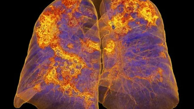 Scans of lungs infected with coronavirus showing areas of pneumonia