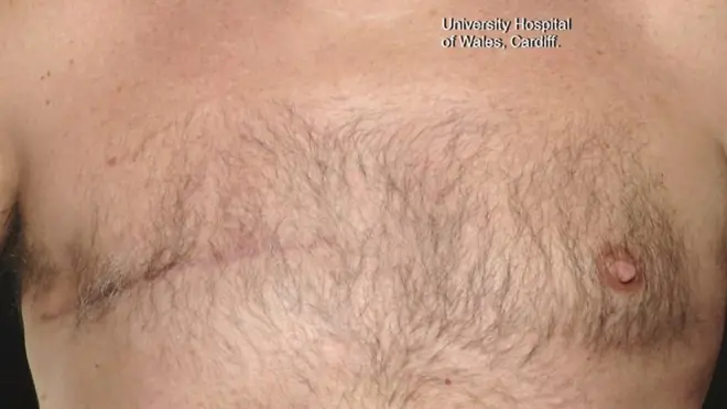 سرطان الثدي يصيب الرجال أيضا