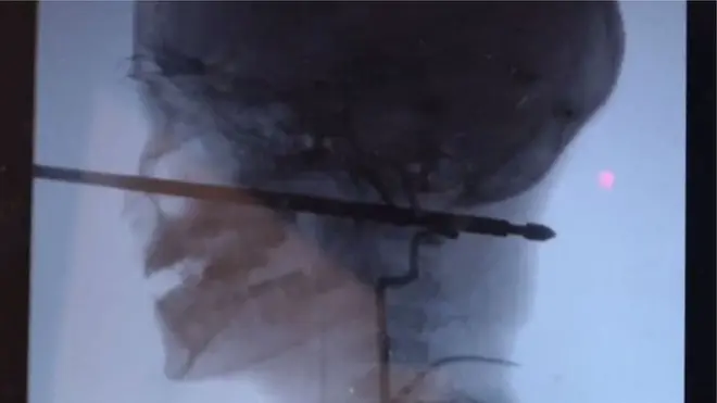 صورة لرأس الصبي يظهر فيها اختراق سيخ لحمي لرأسه