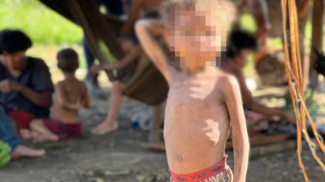 Criança yanomami com sinaisbet 365 como apostardesnutrição