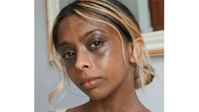 Karishma, msanii wa urembo anayetumia tajriba yake binafsi kuendeleza ujumbe chanya kuhusu ngozi ya mtu, na kusema kwamba bidhaa alizotumia akiwa mtoto zilifanya upele aliokuwa nao kuzidi kabisa