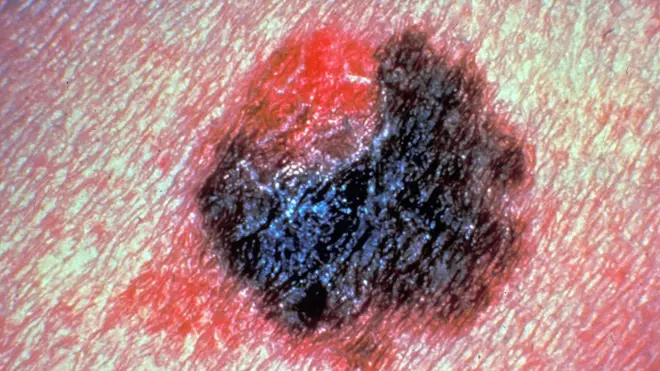 خلية سرطانية