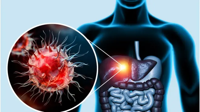 भारतात तरुणांमध्ये कॅन्सरचं प्रमाण का वाढतंय?