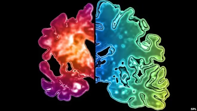 تلف الأنسجة في دماغ مصابة بالخرف مقارنة بأخرى سليمة