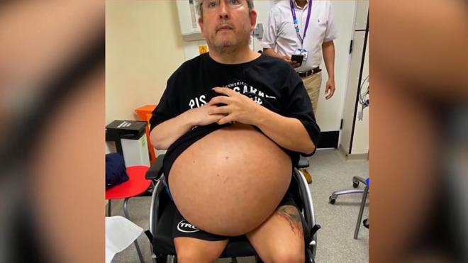 Homem com barriga inchada