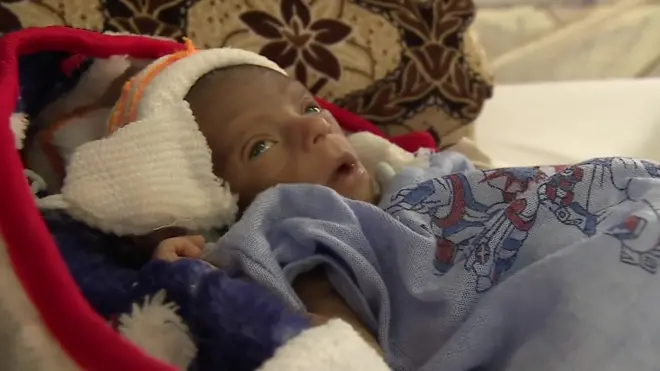 Bebé desnutrido en Yemen