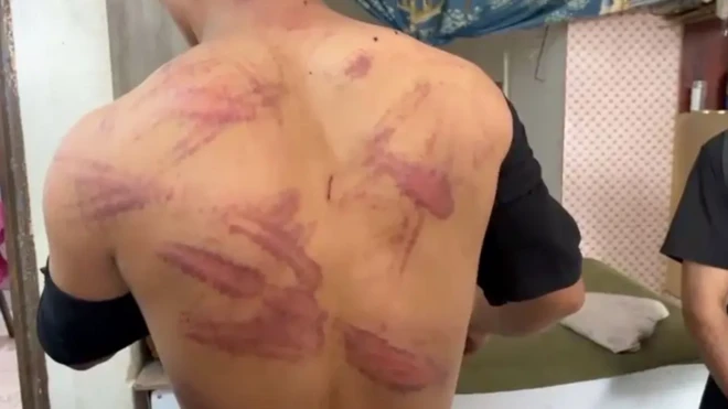 مردی پیراهنش را بالا زده و پشتش پر از کبودی‌های ناشی از کت خوردن نشان می‌دهد