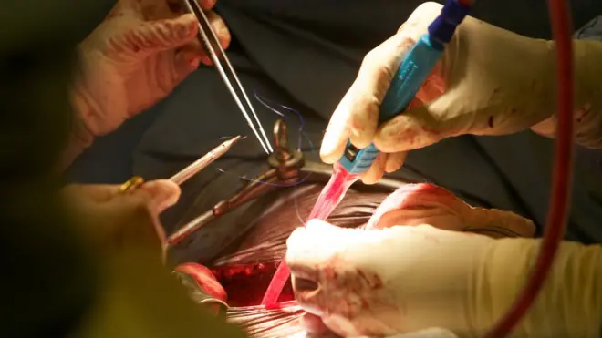 Pig kidney transplant to human: Surgeons Succeed for pig kidney transplant to human body