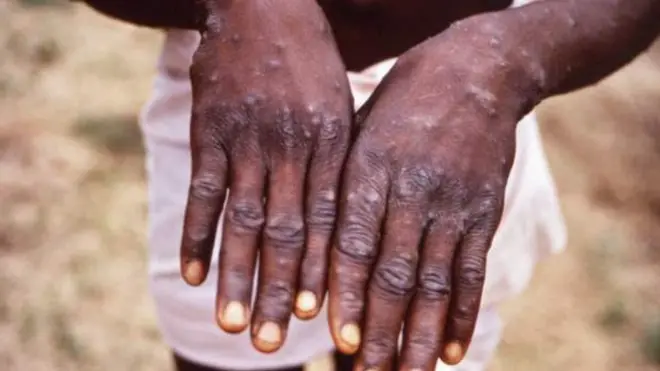 Monkeypox virus no harsh like smallpox but e fit still kill pesin wey get am