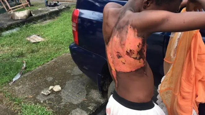 Girl with scar for body