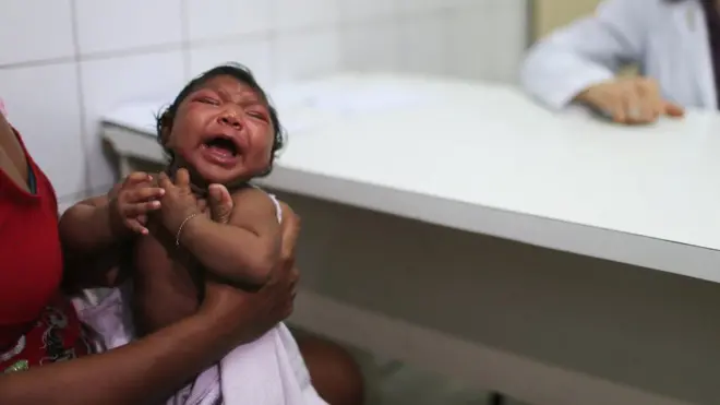 Микроцефалия может развиваться у ребенка в утробе матери или после рождения